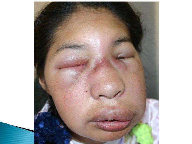 granuloma letal de la linea media
